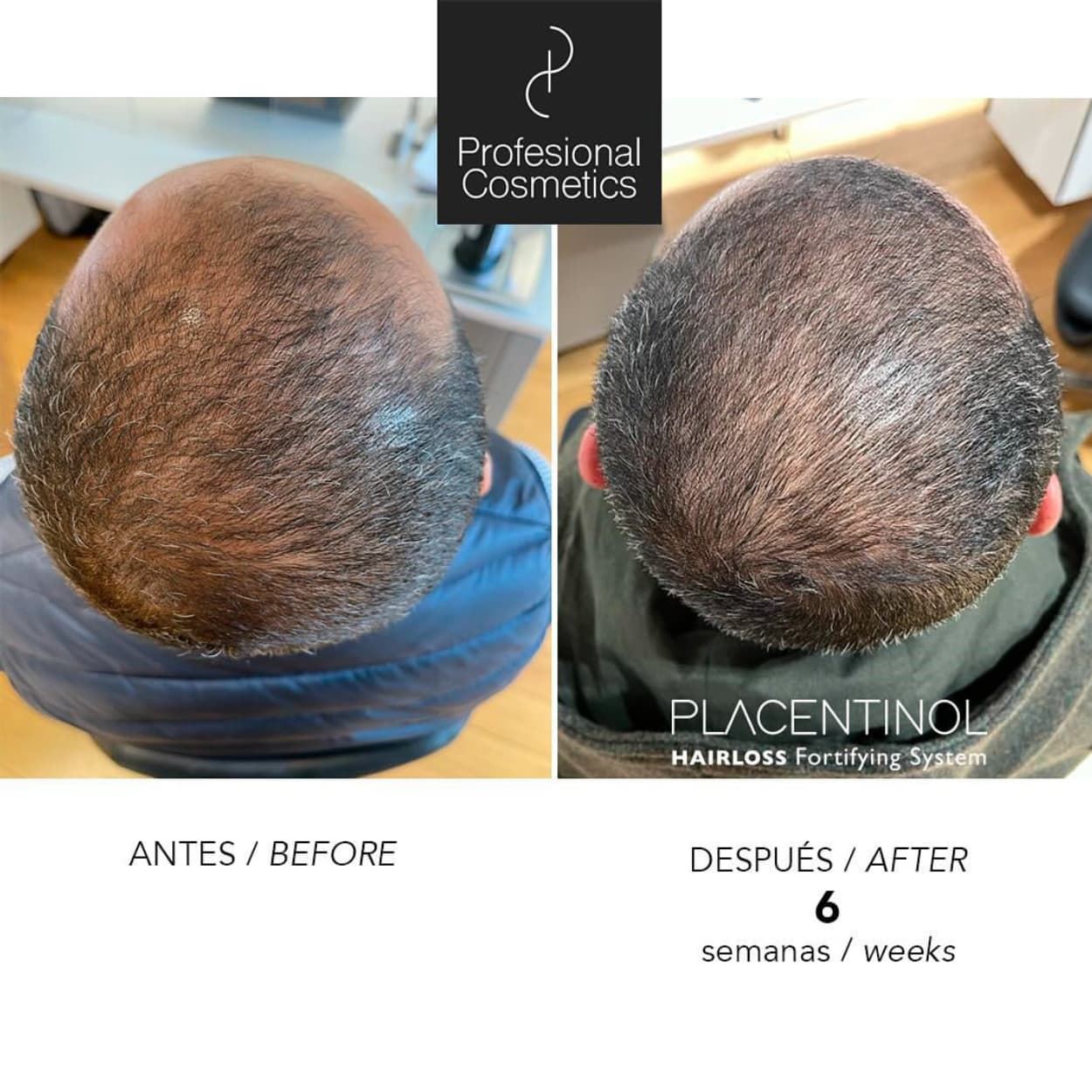 Pack Anticaída Placentinol Acitve + Champu+Locion+Ampollas | Profesional Cosmetics - Imagen 3