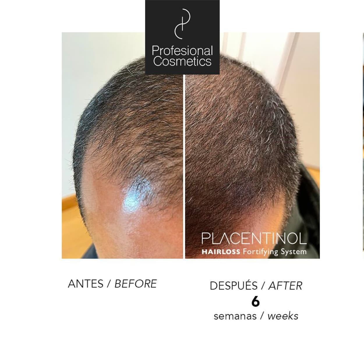 Pack Anticaída Placentinol Acitve + Champu+Locion+Ampollas | Profesional Cosmetics - Imagen 4